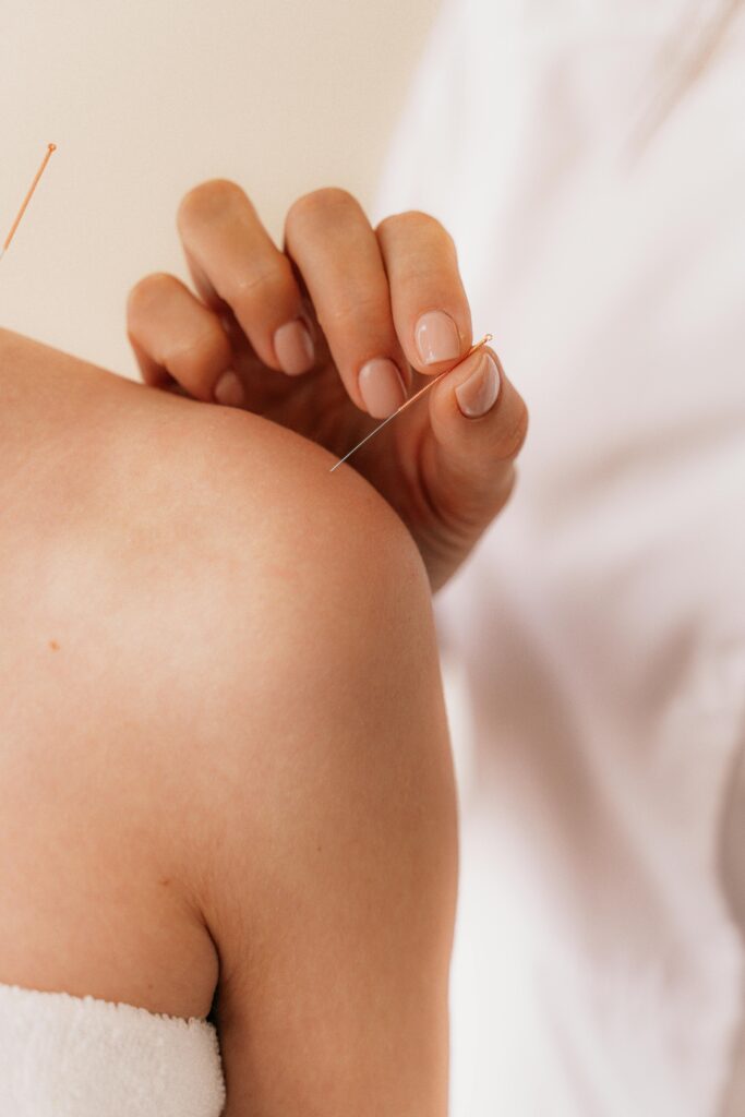 pexels-photo-6076122-6076122 Close-up of acupuncture needle therapy on a patient's shoulder illustrating alternative medicine.